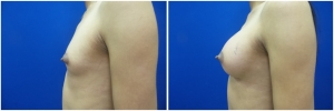 top-surgery-male-to-female-before-after-2-3
