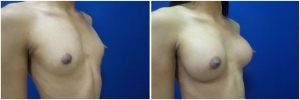 top-surgery-male-to-female-before-after-2-4