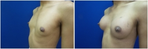 top-surgery-male-to-female-before-after-2-5